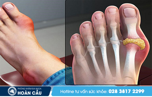 bệnh gout là gì?