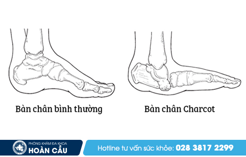 Biến chứng nguy hiểm của bệnh lý khớp thần kinh