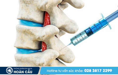 Thoát vị đĩa đệm đốt sống lưng trị như thế nào? - Tiêm Corticosteroid