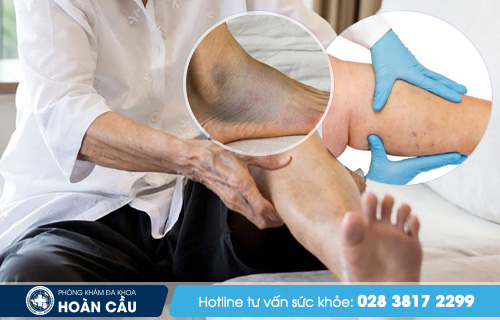 Bệnh phù nề chân: Ttriệu chứng và cách điều trị Nguyen-nhan-gay-benh-phu-ne-chan1