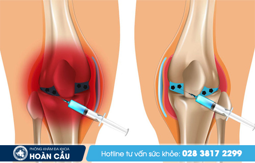 Chọc hút dịch là một trong những cách điều trị viêm bao hoạt dịch khớp gối