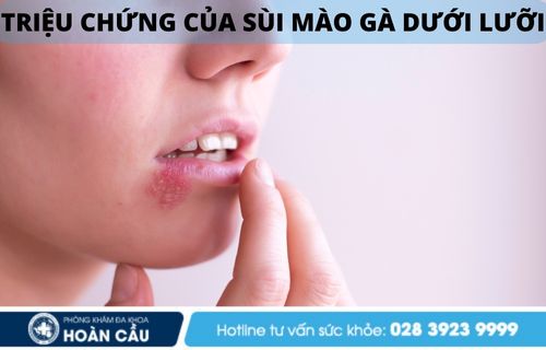 Sức khỏe, đời sống: Sùi mào gà dưới lưỡi - Đa khoa Hoàn Cầu  Sui-mao-ga-duoi-luoi-nguyen-nhan-trieu-chung-va-cach-dieu-tri-hieu-qua-2