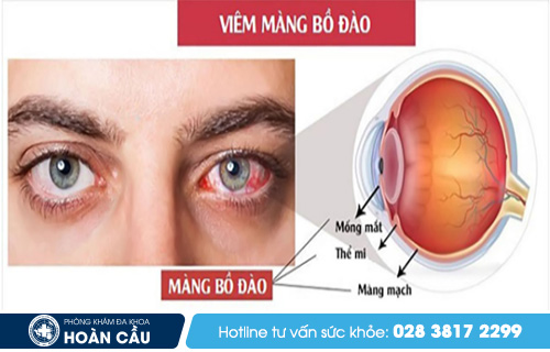 Biến chứng viêm cột sống dính khớp