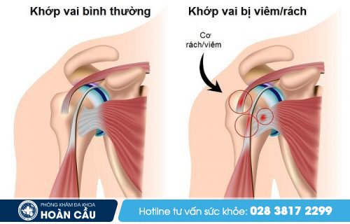 Viêm gân cơ nhị đầu